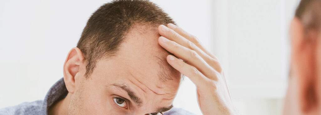 Male-Pattern-Hair-Loss